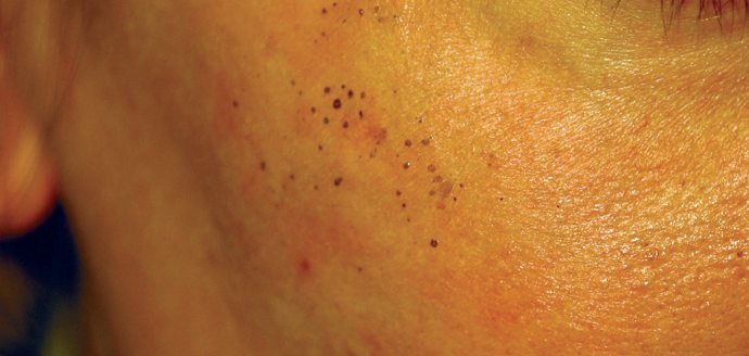 Chromhidrosis Consultant360